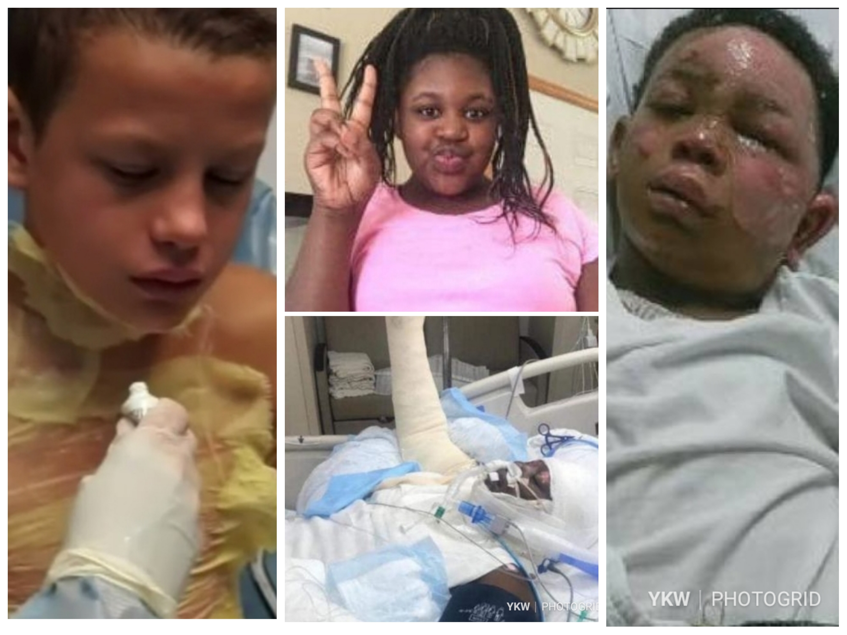 Mothers Warn Public About The “Fire Challenge” After Children Are Severely Burned