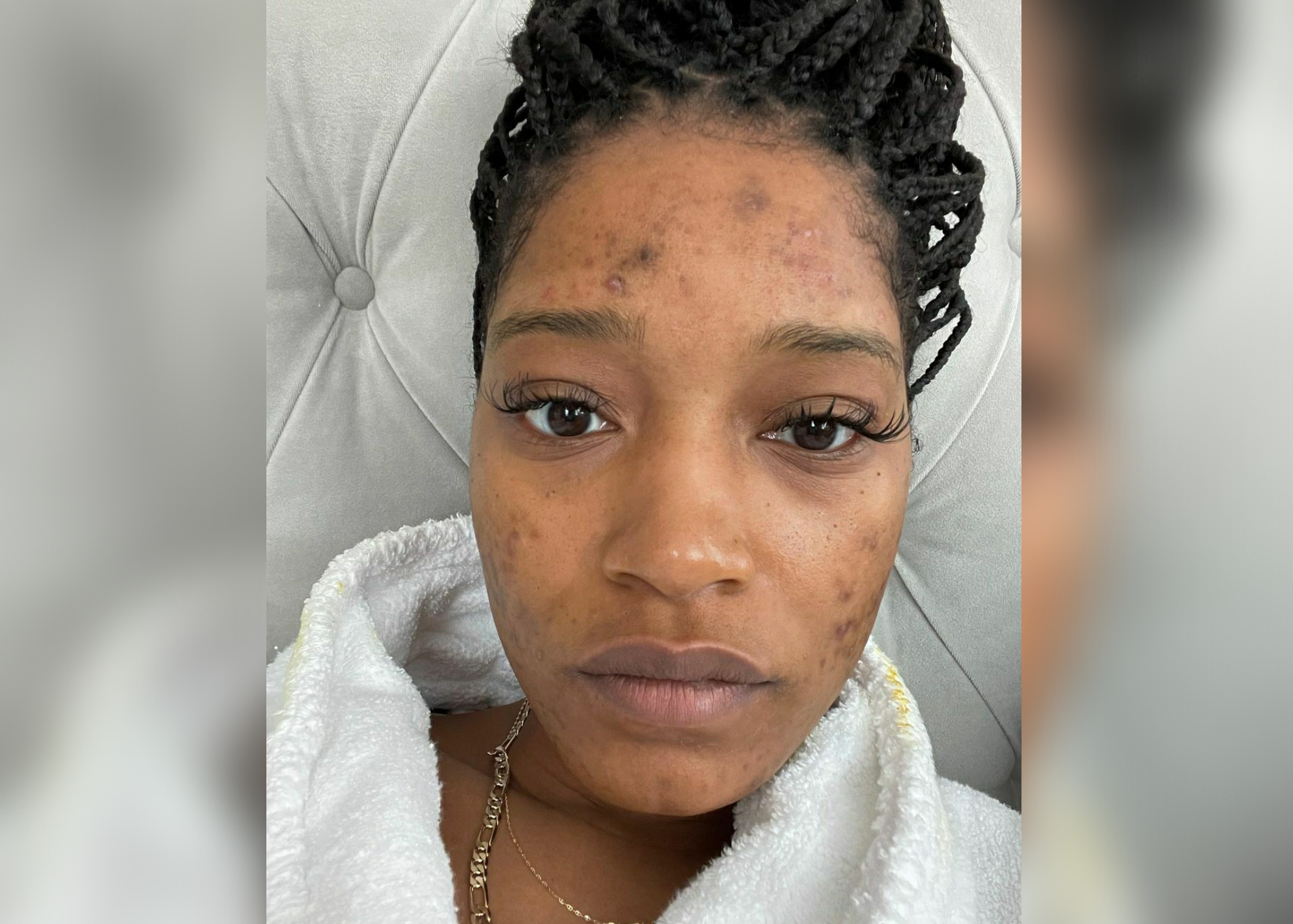 Keke Palmer Opens Up About Her Struggle With PCOS
